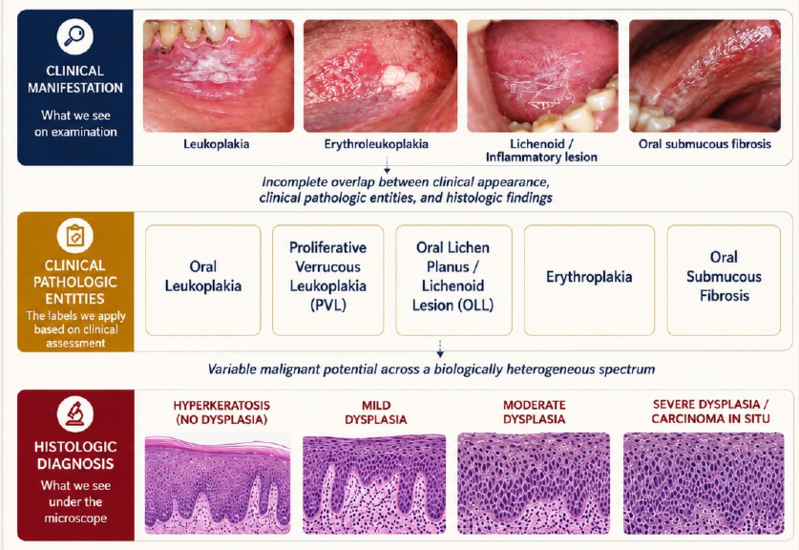 Clinical and histologic spectrum of oral premalignancy from hyperkeratosis through increasing grades of dysplasia